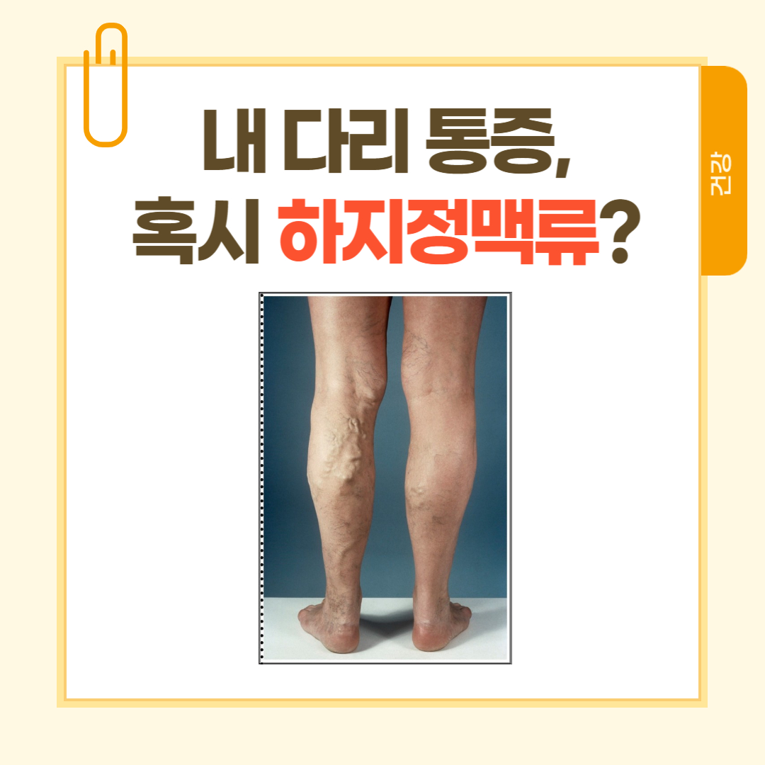 [건강] 하지정맥류, 다리 통증 혹시 내 다리도 하지정맥류 증상일까?